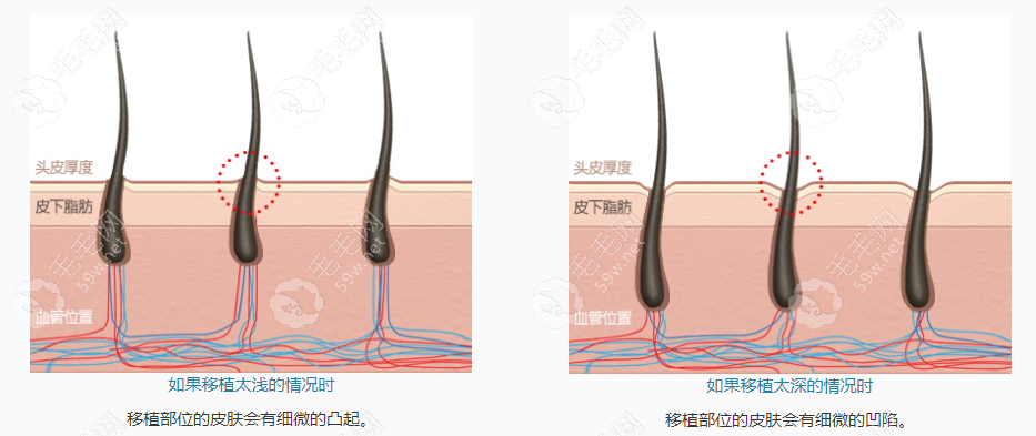 南昌第十二医院种植毛囊深度讲解