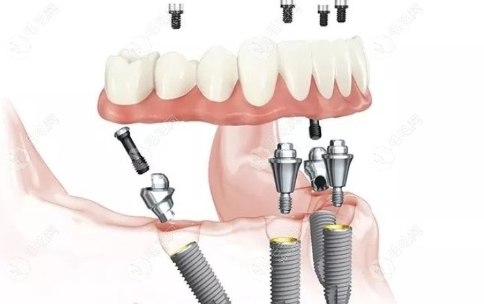 半口allon4种植牙示意图