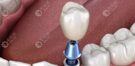 五级钛的种植体有哪些?常见的有ICX、杰美、安卓健等种植体