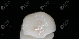 医生为什么让做嵌体而不让做牙冠?网传嵌体补牙后悔一辈子