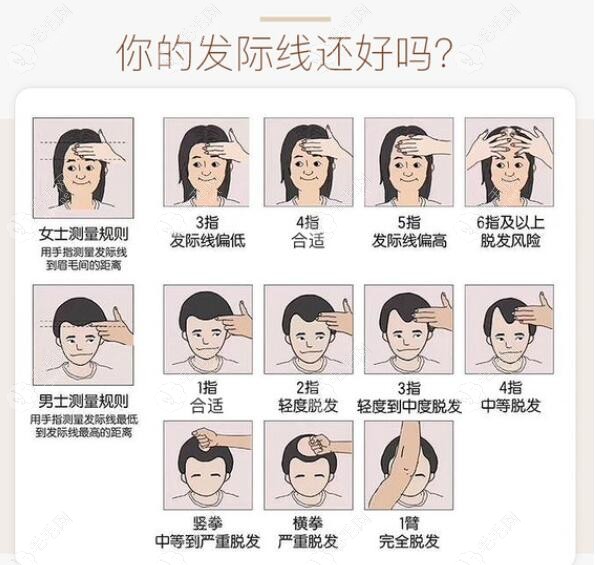 以美容为目的的发际线重塑、鬓角重塑、再造美人尖以及其它部位的加密