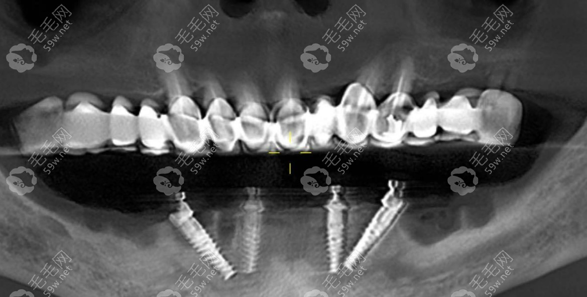 半口allon4种植牙CT照