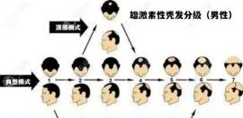 雄性激素脱发研究新进展:雄脱研究成果由吴文育团队详解