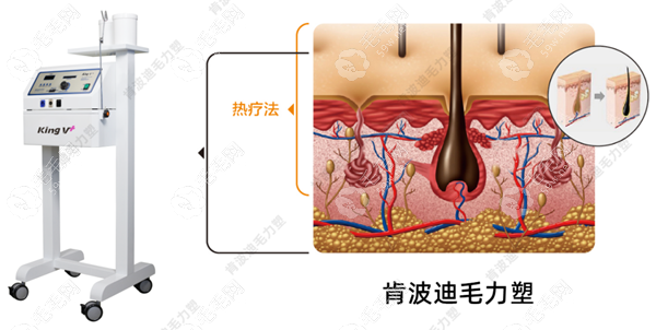 肯波迪是什么？肯波迪是毛囊活化仪可以重塑毛囊动力