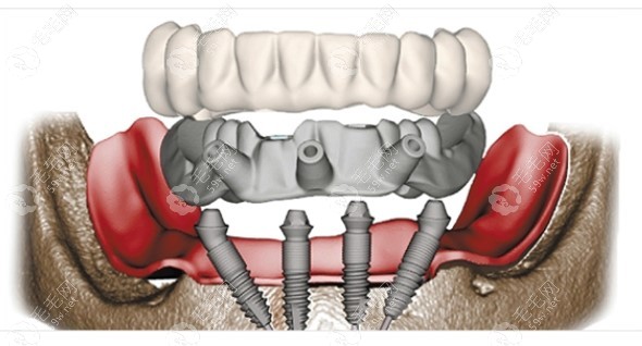 半口allon4种植牙示意图