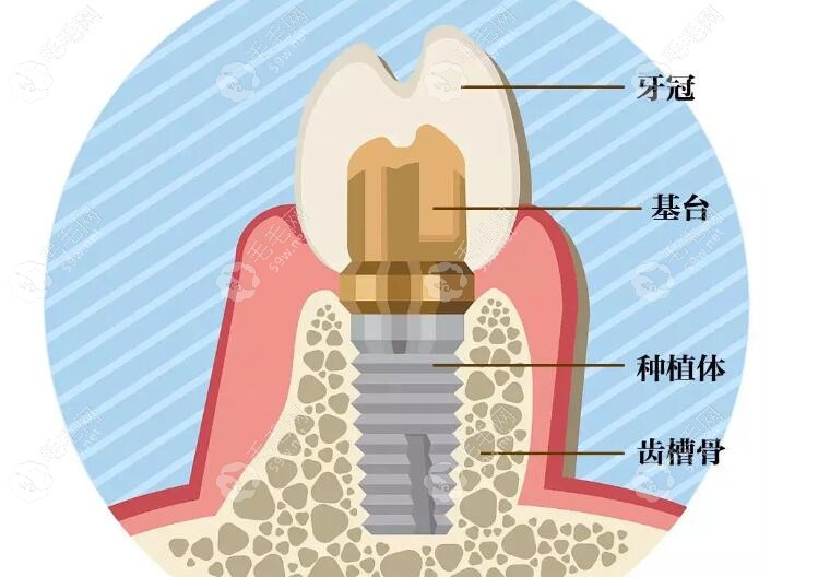 种植牙的结构