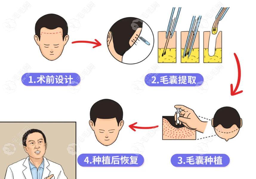 烟台正规的植发医院有哪些？附烟台植发流程示意图