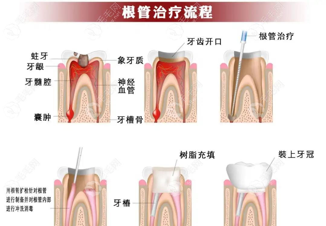 显微镜下根管治疗的优点