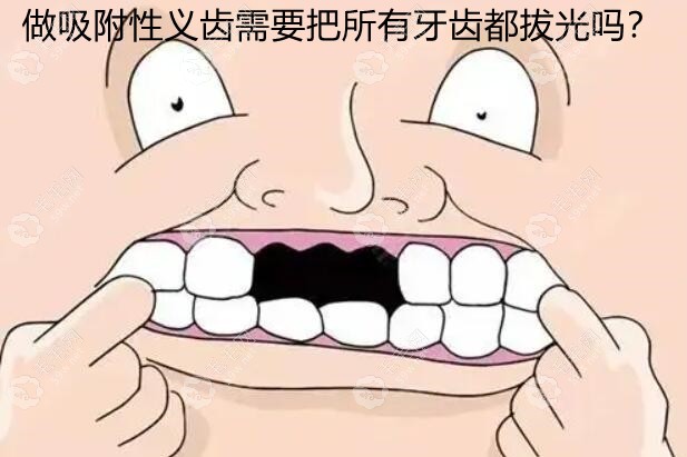 做吸附性义齿要拔光牙齿吗?听说老人是牙齿掉光了才装假牙