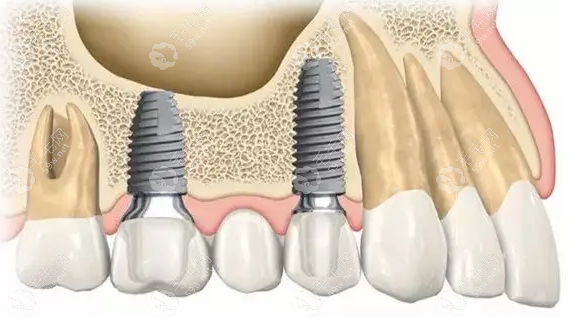 种植牙埋入式和非埋入式有什么区别