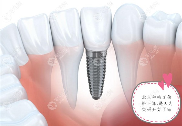 北京种植牙集采还没开始,为什么到处都已是种牙降价的消息