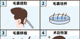 太原植發(fā)好的醫(yī)院是哪個(gè)?比較好的醫(yī)院有顯微/熙朵/麗都哦