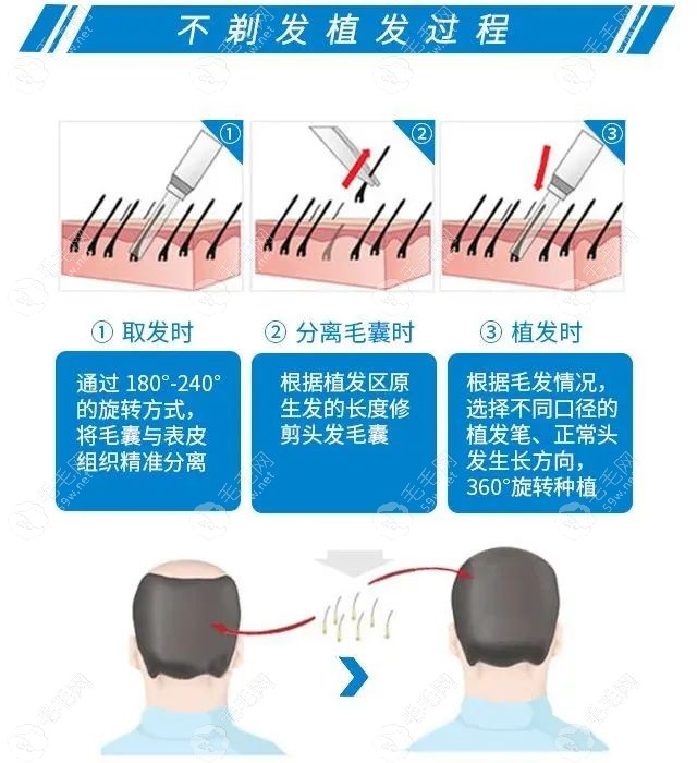 不剃发微针植发技术好还有效,那不剃发微针植发价格是多少