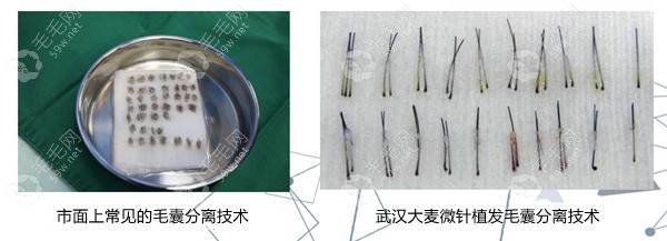 武汉大麦微针植发毛囊分离技术