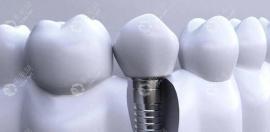 太原哪家医院种植牙技术好且便宜(附太原种牙排名及价格表)