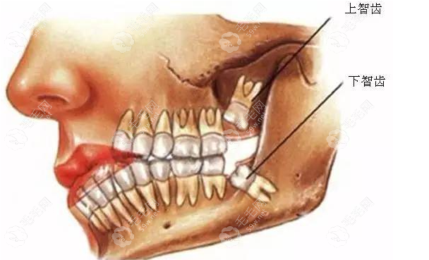 为什么医生都建议将智齿给拔了呢