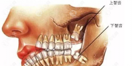 为什么医生都建议将智齿给拔了,细数6大非拔不可的智齿图