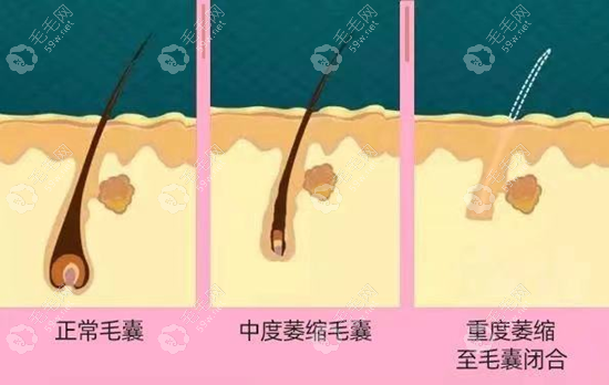 内分泌脱发症状及原因公布,分析内分泌失调脱发多久能恢复