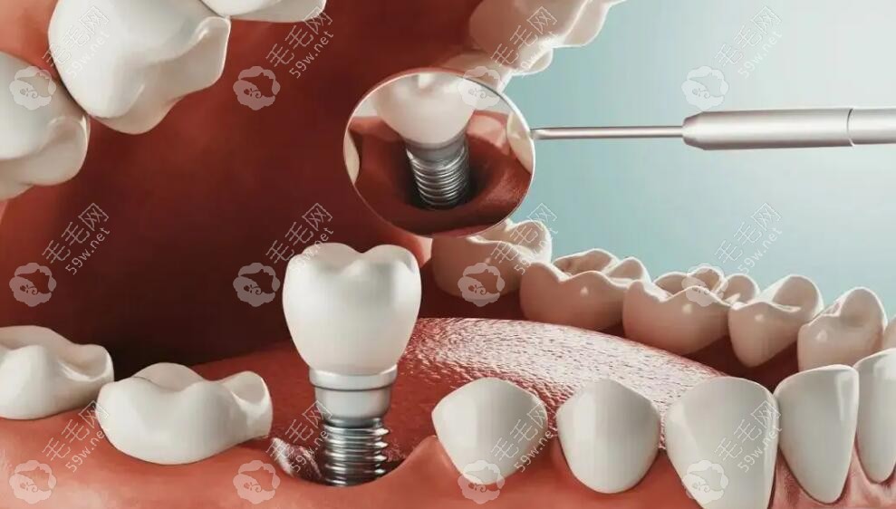 牙槽骨吸收导致种植体松动