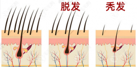 絲科慕和米諾地爾哪個(gè)療效好,治療脂溢性脫發(fā)/雄脫選誰(shuí)？