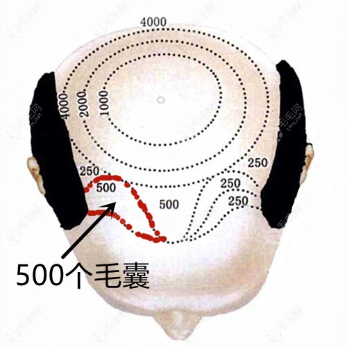 分享500个毛囊植发面积图,你猜500个毛囊单位植发多少钱