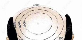 分享500个毛囊植发面积图,你猜500个毛囊单位植发多少钱