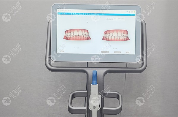 隐形正畸方案模拟图59w.net