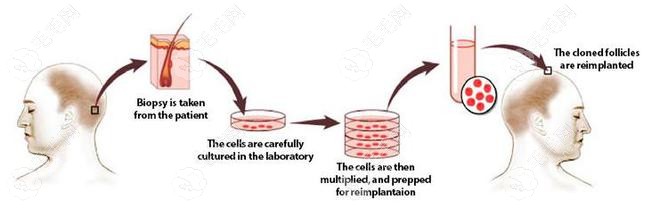自体毛囊再生技术技术成熟了吗59w.net