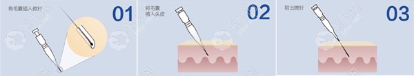 pse微针植发技术流程