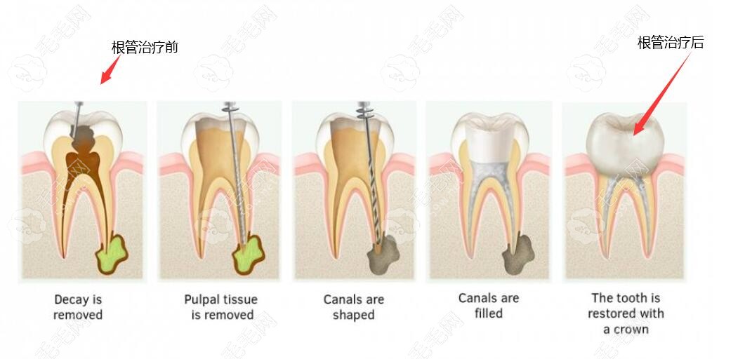 根管治疗后的样子
