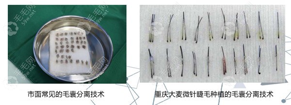 重庆大麦微针毛囊分离技术差异