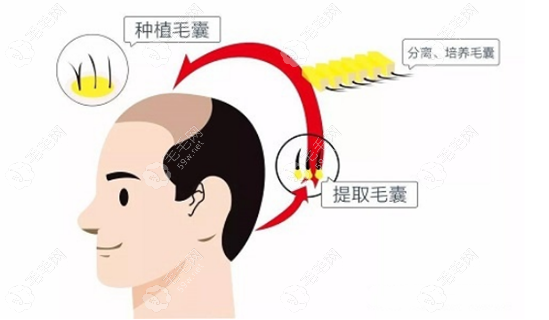 南京领秀毛发移植过程