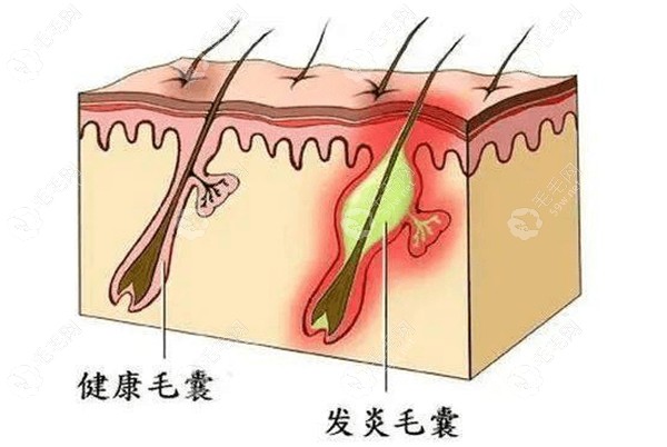 头皮长了毛囊炎疙瘩怎么治疗有效