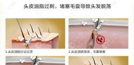 頭皮毛囊炎是什么原因引起的?長了毛囊炎疙瘩怎么治療有效