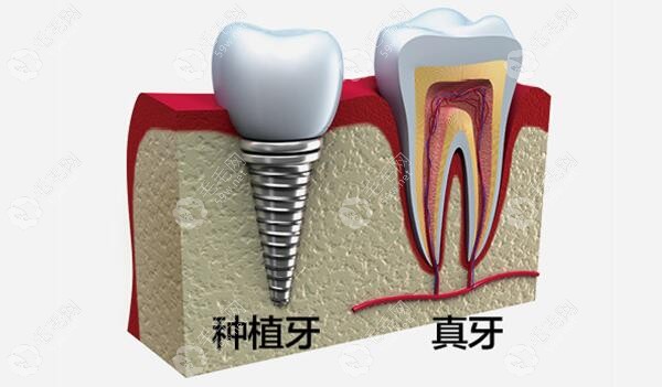 2023年在正规牙科做种植牙价格有降低