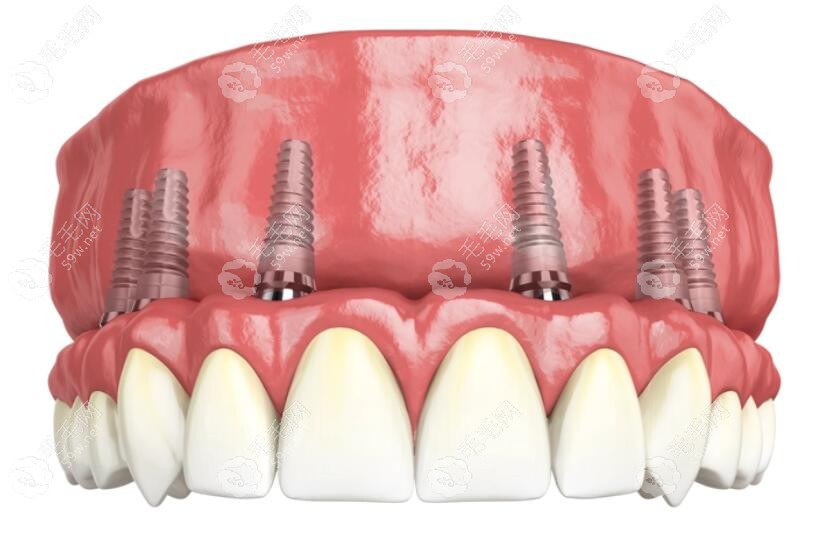全口种植牙的模拟图