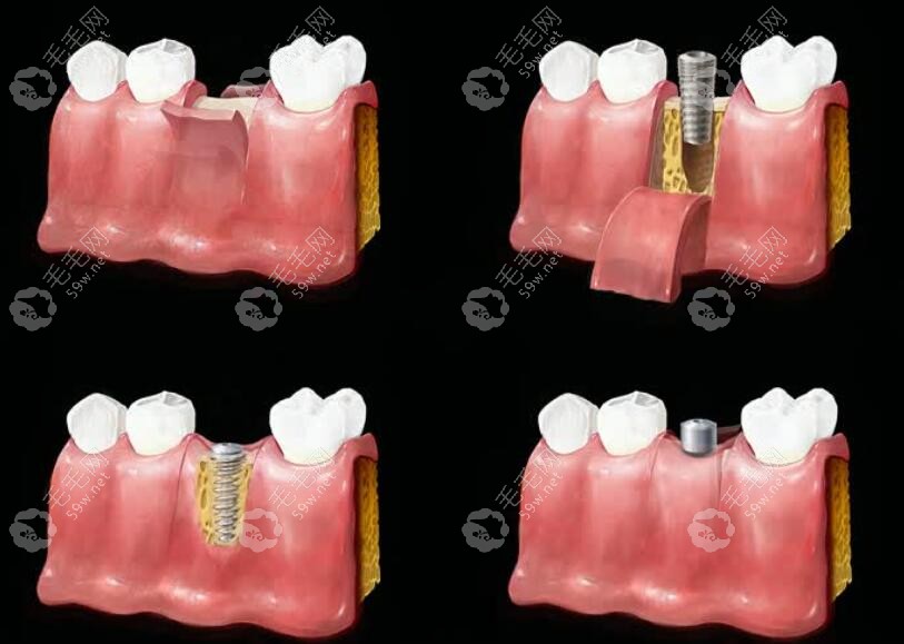 种植牙过程图