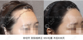 韓國做發(fā)際線植發(fā)例子多嗎?韓國毛杰琳種發(fā)際線實(shí)例有很多
