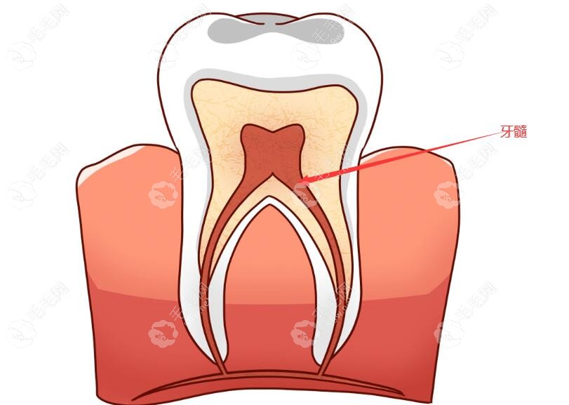 根管治疗主要是治疗牙髓部位