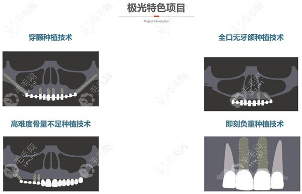 极光口腔的特色种植技术