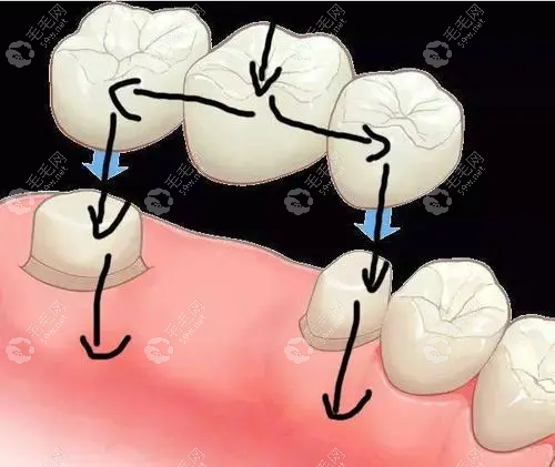种牙和搭桥哪个牢固