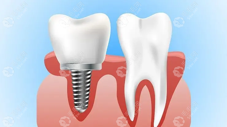 缺单颗牙种植还是搭桥好
