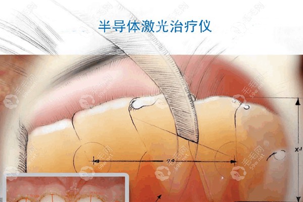 用水激光补牙及拔牙、治疗牙周病的优点