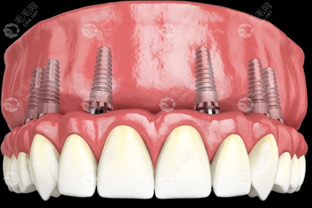老年人全口假牙费用www.59w.net