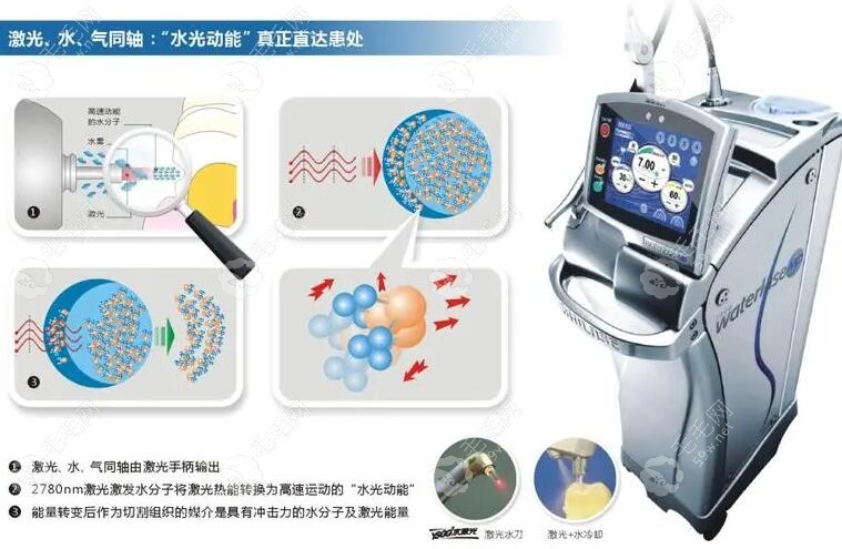 用水激光拔牙,补牙及治疗牙周炎,牙髓炎的作用和优势浅析