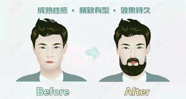 种植胡须后成效示意图