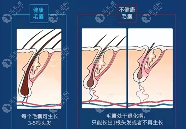 西德瑞微针可以赋活毛囊