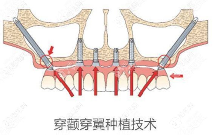 穿颧穿翼种植牙价格:半口25万起适合无牙槽骨种植