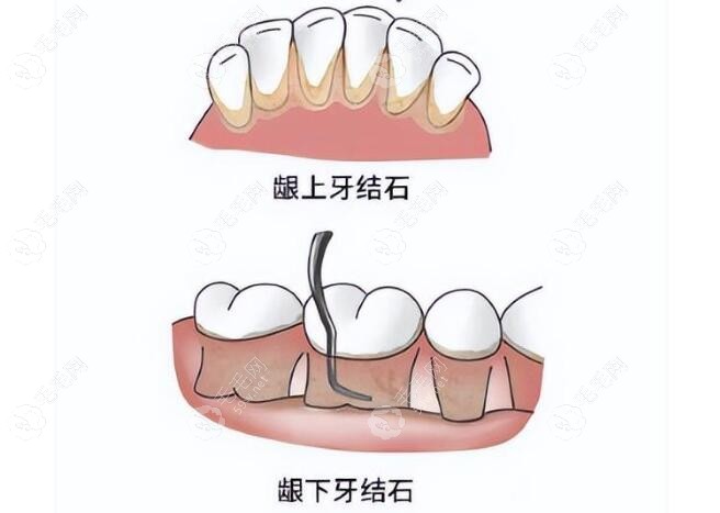 龈上洁治术和龈下洁治