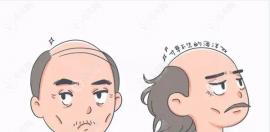 50歲頭發(fā)越來越少怎么辦?想知道我這個年齡還有必要植發(fā)嗎